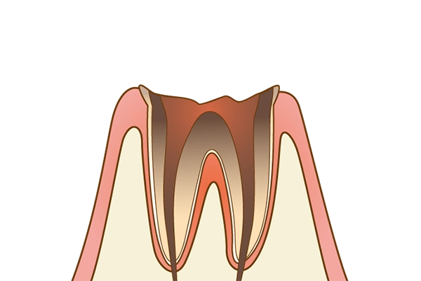 C4(歯根まで進行した虫歯)