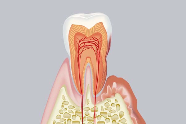 中等度歯周病の治療