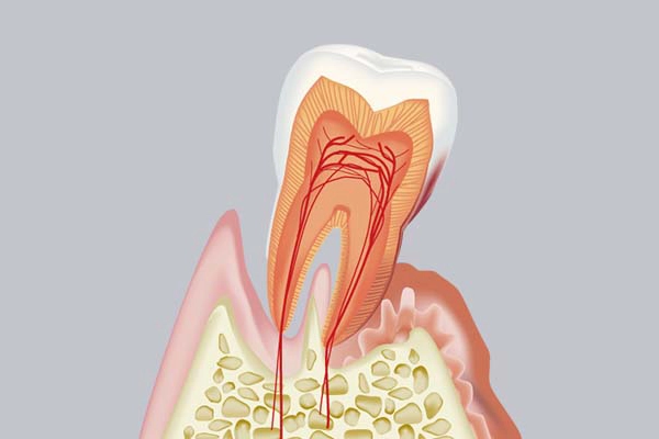 重度歯周病の治療