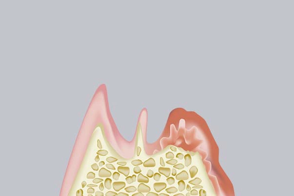 最重度歯周病の治療