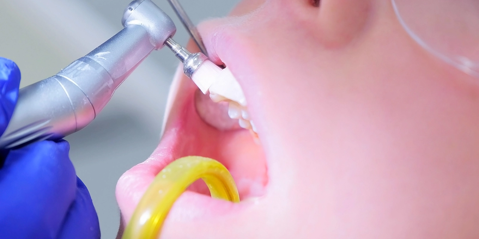 プロフェッショナルケア(歯科医院で行うケア)